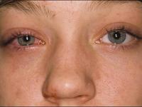 Что такое кератит глаз