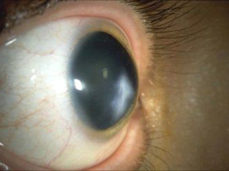 Лечение кератита глаз
