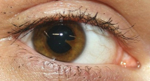 Передние синехии глаза