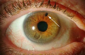 Описание заболевания закрытоугольной глаукомы