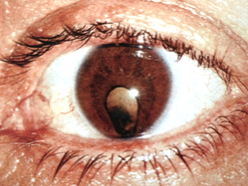 Что делать с патологии глаза