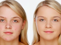 Особенности лечения подкожного клеща на лице