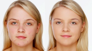 Особенности лечения подкожного клеща на лице