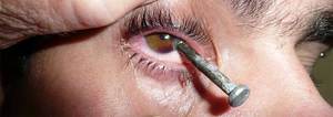 Травма глаза - первая помощь