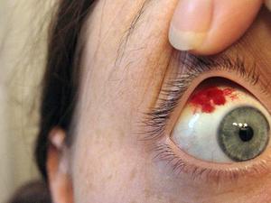 Кровоизлияние внутри глаза - диагностика