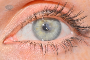 Поверхностные повреждения глаз лечатся дома