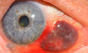 Разные травмы глаза - степени и лечение