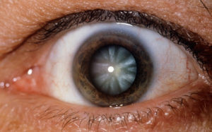 Возникновение катаракты