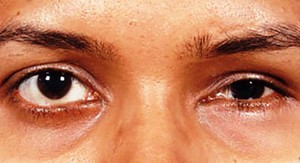 Экзофтальм левого глаза - пучеглазие, фото пациента