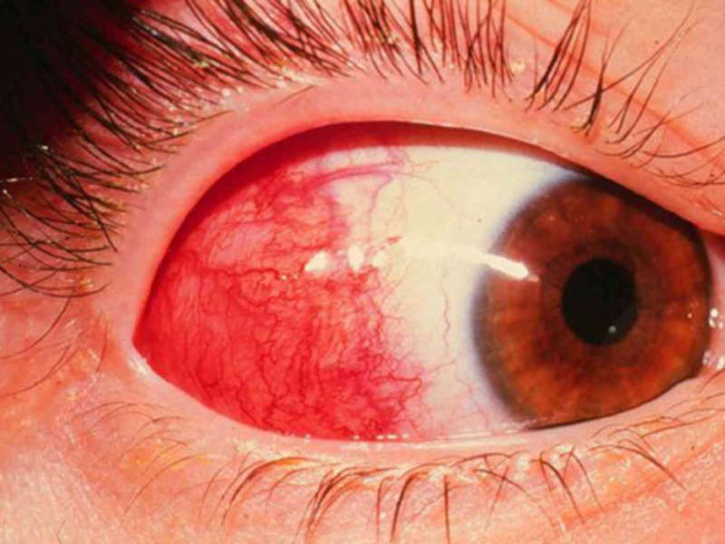 Как лечить склерит глаз