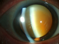 Факосклероз хрусталика глаз