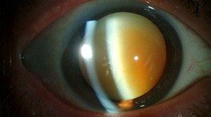 Факосклероз хрусталика глаз