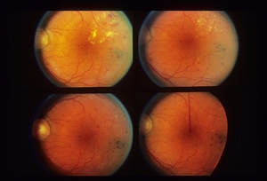 Что такое ретинопатия