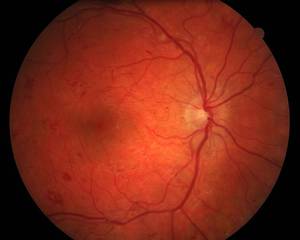 Способы лечения ретинопатии