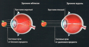 Спазм глазных мышц