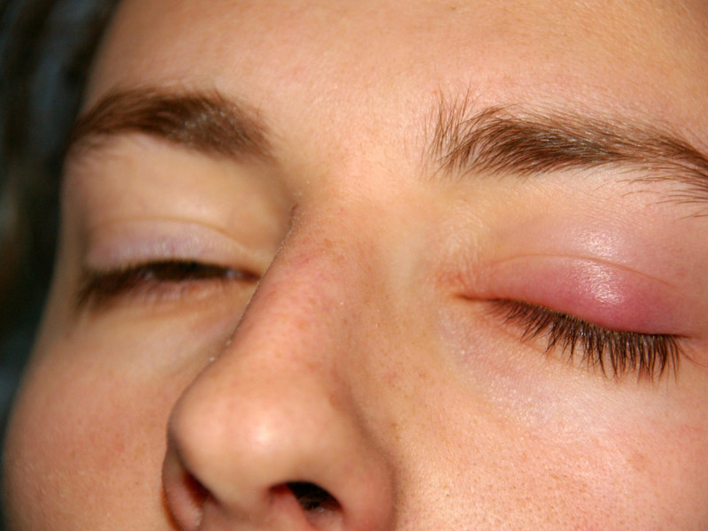 Лечение восспаления глаз