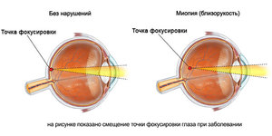На рисунке показано смещение точки фокусировки глаза при миопии
