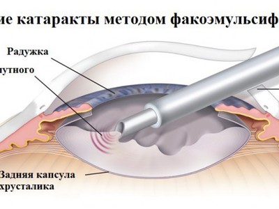 Ультразвуковая катаракта