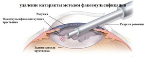 Операция факоэмульсификации катаракты 