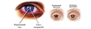 Сравнение здорового и больного глаза