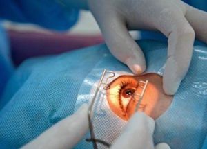 Хирургия глаза