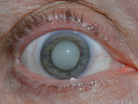 Катаракта – это частичное или полное помутнение хрусталика глаза