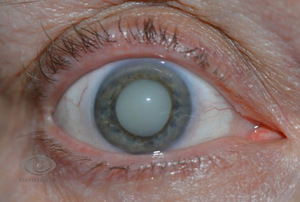 Катаракта – это частичное или полное помутнение хрусталика глаза