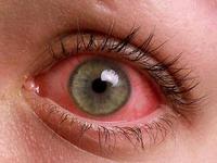 Красные глаза у больного человека