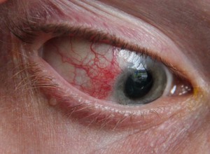 Кератит - заболевание глаз