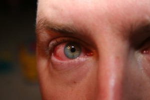 Противопоказания и побочные эффекты от глазных капель Систейн