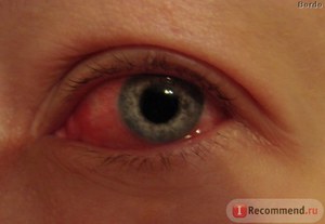 Заболевание глаза
