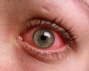 Коньюктивит – воспаление глаз