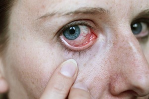 Симптомы передозировки глазных капель Ксалатан