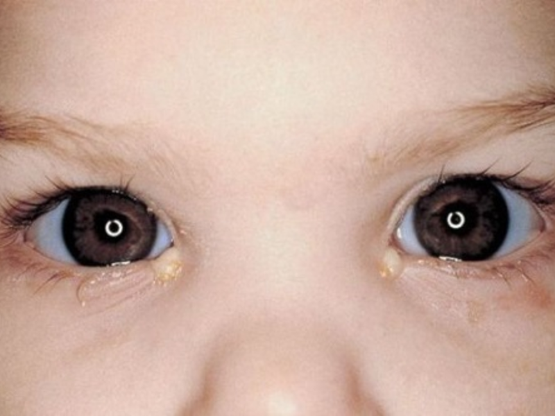 Модно использовать у новорожденных при гноящихся глазках