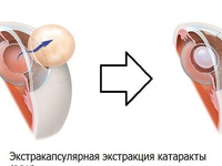 Хирургическое лечение катаракты