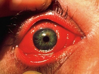 Конъюнктивит - симптомы заболевания глаз