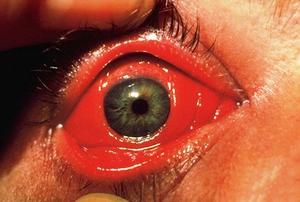 Конъюнктивит - симптомы заболевания глаз