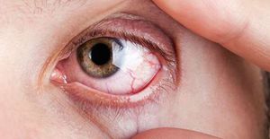 Глазные болезни у взрослых