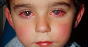 Заболевание глаз в педиатрии