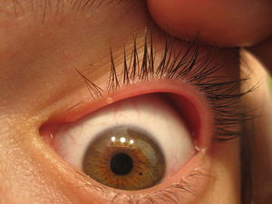 Блефарит- заболеване глаз