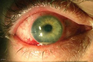 Эндофтальмит - заболевание глаз