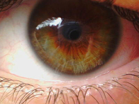 Как лечить дистрофию глаза