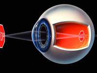Что такое рефракция глаза - определение