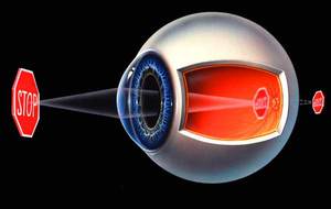 Что такое рефракция глаза - определение