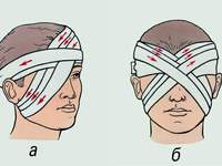 Как наложить повязку на глаз