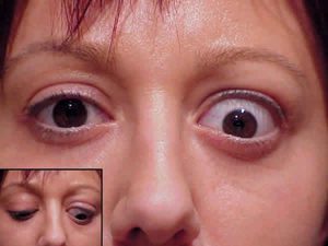 Болезни глазных мышц